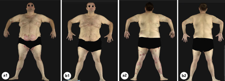 Janus Kinase Inhibitors as Successful Treatment Alternative in Dupilumab-Induced Psoriasis.