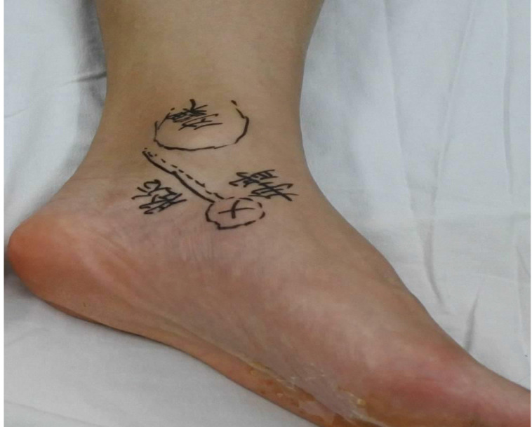 Clinical Effects of Tibial Posterior Tendon Reconstruction in the Treatment of Young Athletes With Accessory Navicular Bone Syndrome.