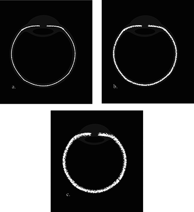 The Diagnostic Utility of Contrast-Enhanced FLAIR Imaging in the Diagnosis of Pediatric Uveitis.