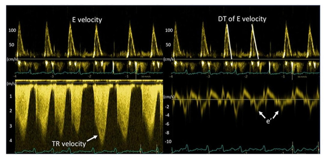 Evaluation of left ventricular filling pressure by echocardiography in patients with atrial fibrillation.
