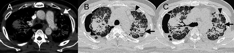 Successful lung transplantation for artificial stone-associated accelerated silicosis: a case report.