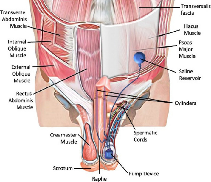 Long-term results of three-part penile prosthesis implantation with Ectopic reservoir placement in the treatment of erectile dysfunction: is supramuscular tubulation a reliable method?