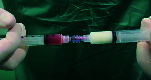Stone-induced urethral fistula treatment with microfragmented adipose tissue containing mesenchymal stem cells: a case report from veterinary medicine with potential application in humans.
