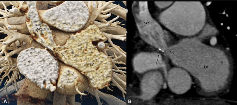Delayed Presentation of Baffle Obstruction in an Adult Post-Mustard Repair of Transposition: Computed Tomography Demonstration.