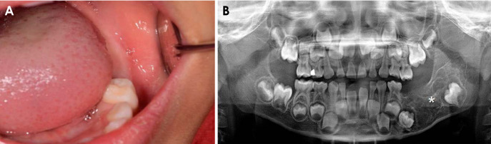 A rare case report of ameloblastic fibrodentinoma with imaging features in a pediatric patient.