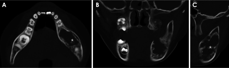 A rare case report of ameloblastic fibrodentinoma with imaging features in a pediatric patient.