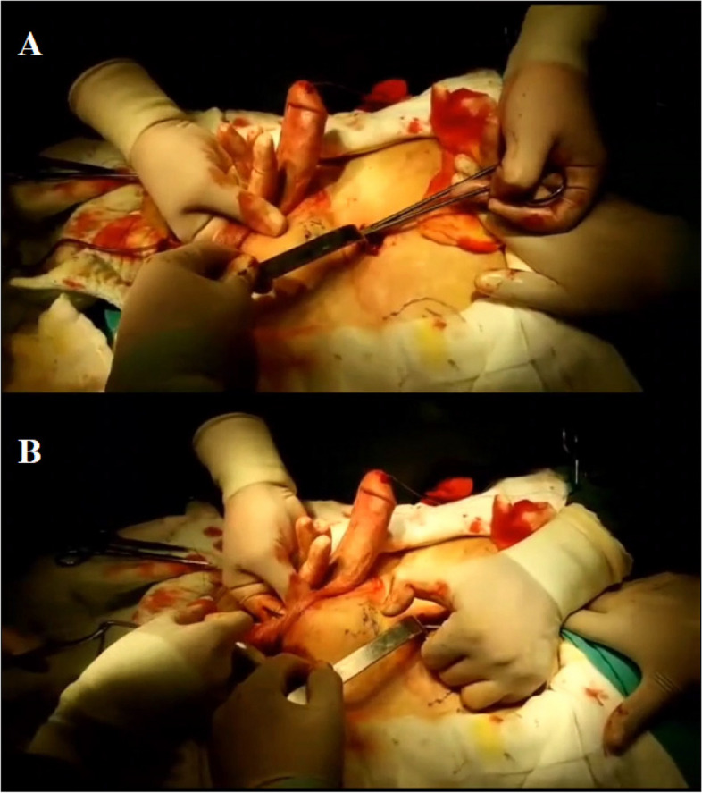 Long-term results of three-part penile prosthesis implantation with Ectopic reservoir placement in the treatment of erectile dysfunction: is supramuscular tubulation a reliable method?