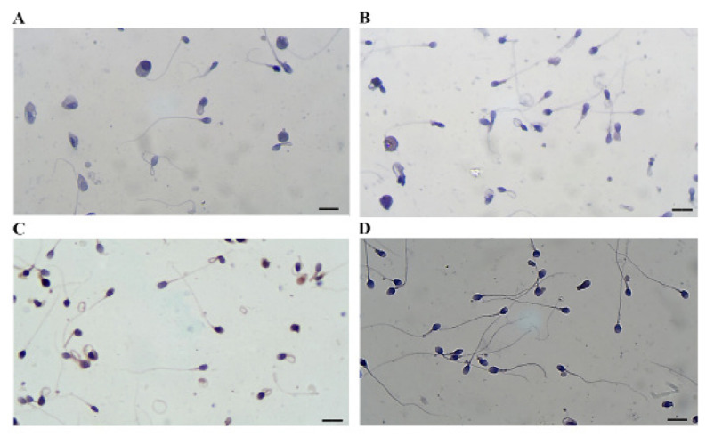 The Effects of Varicocelectomy on Sperm DNA Fragmentation and Conventional Semen Parameters in Men with Severe Oligoasthenoteratozoospermia: A Prospective Study.