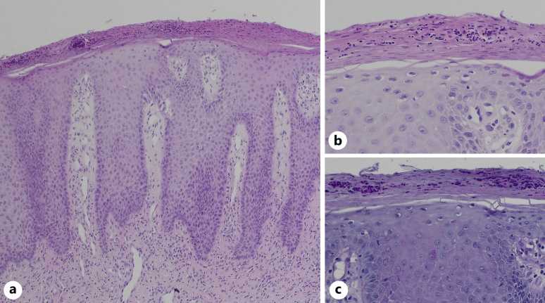 Janus Kinase Inhibitors as Successful Treatment Alternative in Dupilumab-Induced Psoriasis.