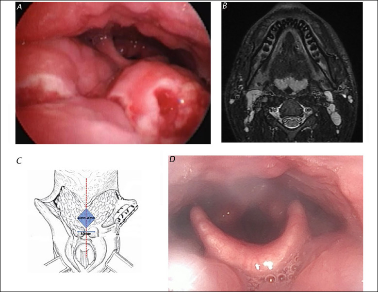 Transoral robotic surgery tongue base debulking in Castleman's disease.