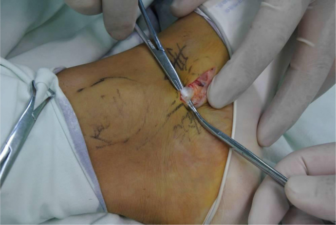 Clinical Effects of Tibial Posterior Tendon Reconstruction in the Treatment of Young Athletes With Accessory Navicular Bone Syndrome.