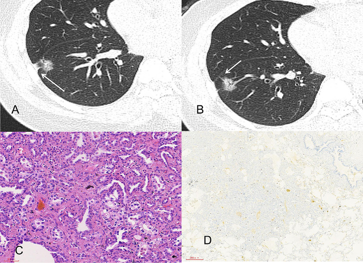 Nomogram for the preoperative prediction of Ki-67 expression and prognosis in stage IA lung adenocarcinoma based on clinical and multi-slice spiral computed tomography features.
