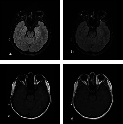 The Diagnostic Utility of Contrast-Enhanced FLAIR Imaging in the Diagnosis of Pediatric Uveitis.