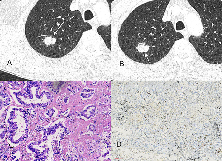 Nomogram for the preoperative prediction of Ki-67 expression and prognosis in stage IA lung adenocarcinoma based on clinical and multi-slice spiral computed tomography features.