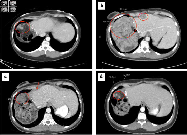 Complete Pathologic Response to Gemcitabine and Oxaliplatin Chemotherapy After Prior Therapies in a Patient With Hepatocellular Carcinoma and Peritoneal Metastases Undergoing Cytoreductive Surgery and Hyperthermic Intraperitoneal Chemotherapy.