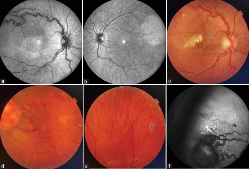 The rare diagnosis of Von Hippel-Lindau disease in a 29-year-old patient.