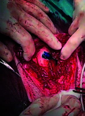 Stone-induced urethral fistula treatment with microfragmented adipose tissue containing mesenchymal stem cells: a case report from veterinary medicine with potential application in humans.