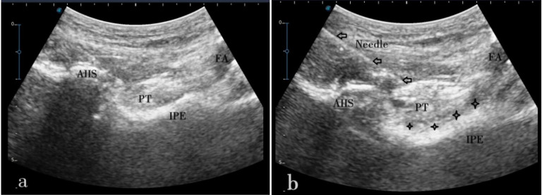 Application of Hip Pericapsular Nerve Block Combined With Spinal Anesthesia in the Treatment of Elderly Patients With Femoral Intertrochanteric Fracture.
