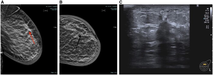 Architectural distortion on digital breast tomosynthesis mammograms in symptomatic breast clinics: what are the result outcomes?
