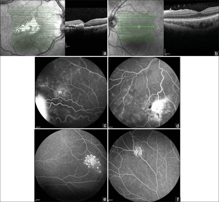 The rare diagnosis of Von Hippel-Lindau disease in a 29-year-old patient.