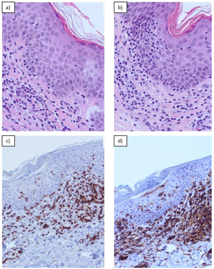 The Prognostic Value of Histopathological Features in Early-Stage Mycosis Fungoides: Insights from a Retrospective-Prospective Cohort Study.