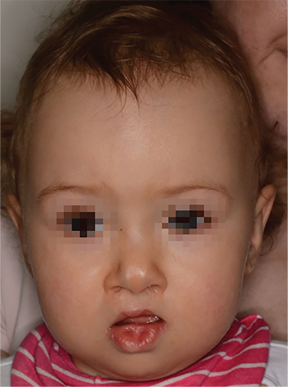 Surgical Treatment of Lip Pits in Van der Woude Syndrome: A Preliminary Retrospective Study of 24 Patients.