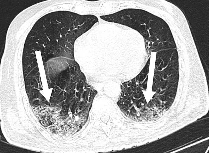 A Rare Case of Coronavirus Disease 2019 Encephalitis Mimicking Creutzfeldt-Jacob Disease in an Immunocompromised Patient: A Case Report.