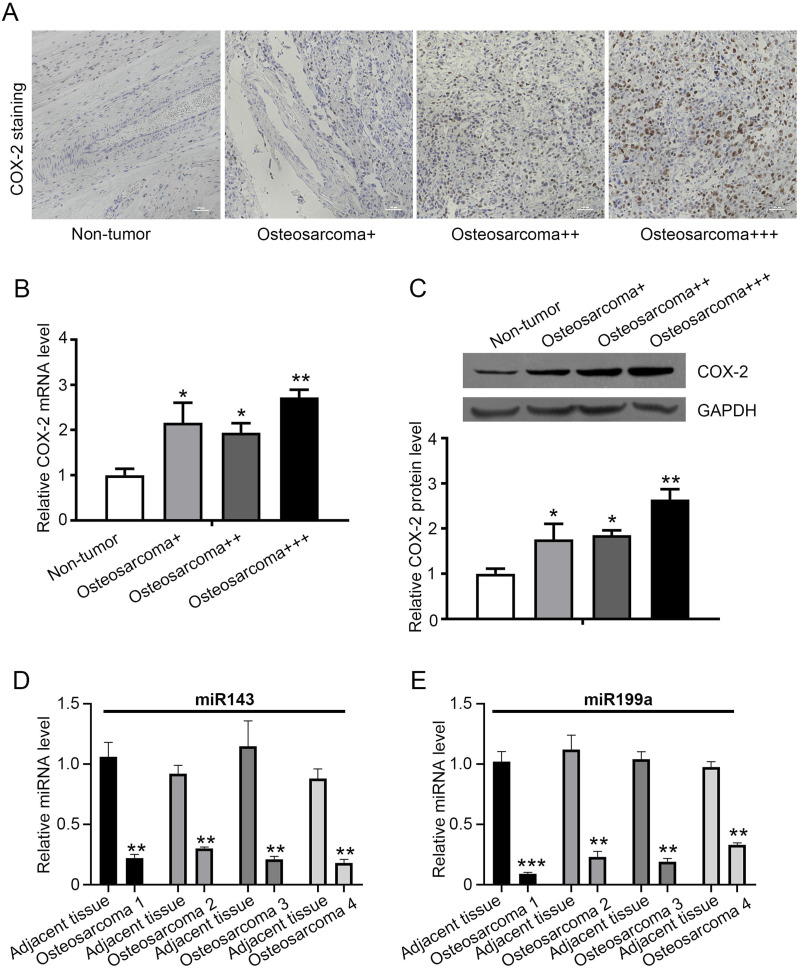 Regulation of Osteosarcoma Cell Proliferation, Migration, and Invasion by miR-143 and miR-199a Through COX-2 Targeting.