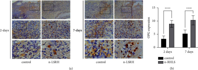 Nanoparticle-Based Rice Husk Liquid Smoke as Periodontitis Therapy through OPG, RANK, and RANKL Expression.