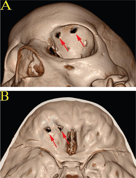 Orbital Cerebrospinal Fluid Leak After Dog Bite: A Case Report
