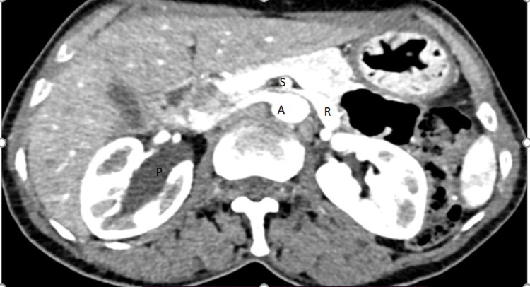 Case Report; Concomitant Left Nutcracker Syndrome and Right Ureteropelvic Junction Obstruction.