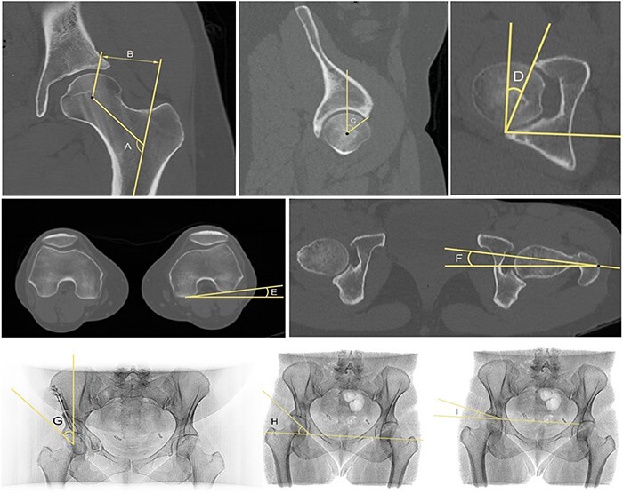 Understanding recurrent groin pain following periacetabular osteotomy: assessment of psoas tendon mechanics using discrete element analysis.