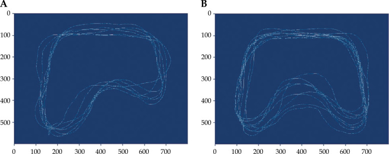MRI-guided brachytherapy for cervical cancer treatment: The significance of bladder morphology in dose distribution planning.