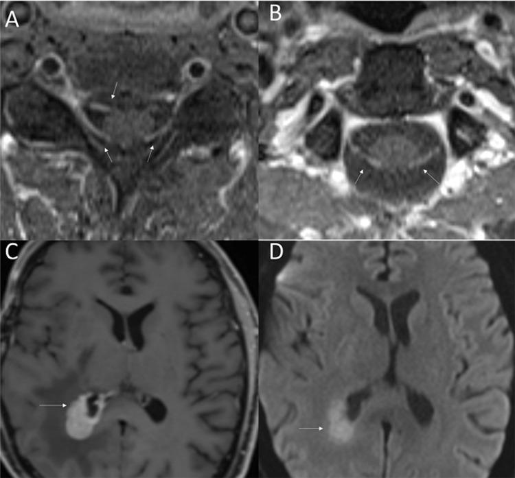 Clinical and Genomic Profile of Primary Cranial Neurolymphomatosis.