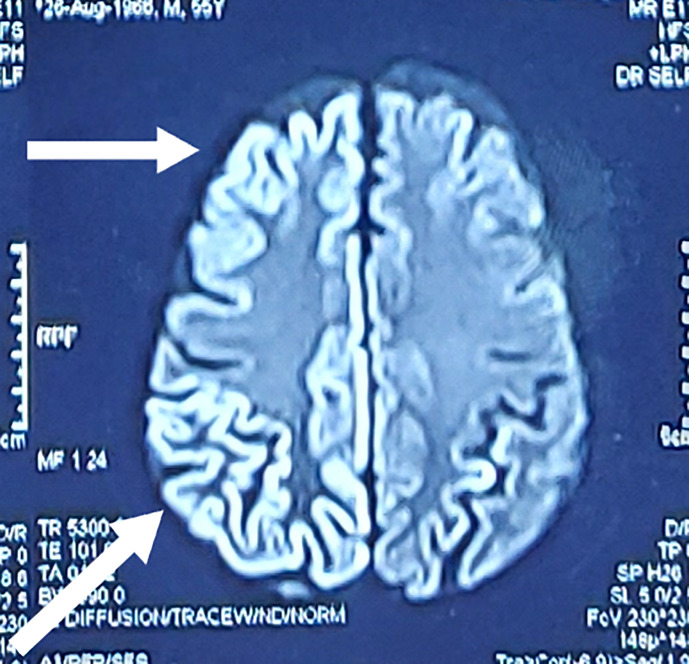 A Rare Case of Coronavirus Disease 2019 Encephalitis Mimicking Creutzfeldt-Jacob Disease in an Immunocompromised Patient: A Case Report.