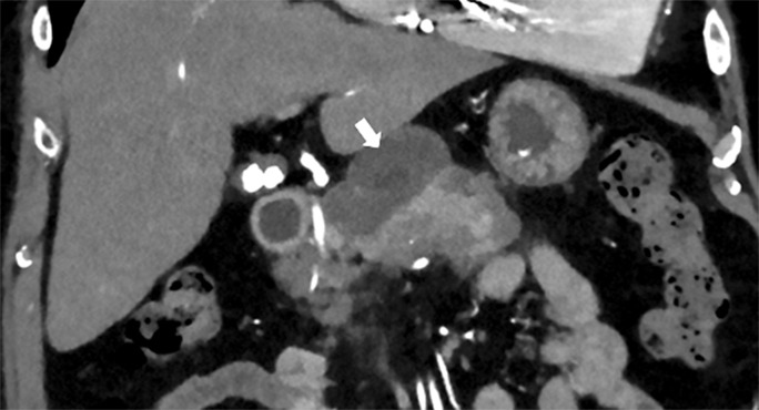 Peritonitis in Peritoneal Dialysis: When to Consider Acute Pancreatitis? Case Report and Mini-Review.