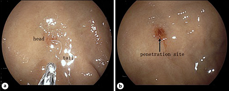 A Case of Nonagenarian Gastric Anisakiasis with Atypical Presentation.