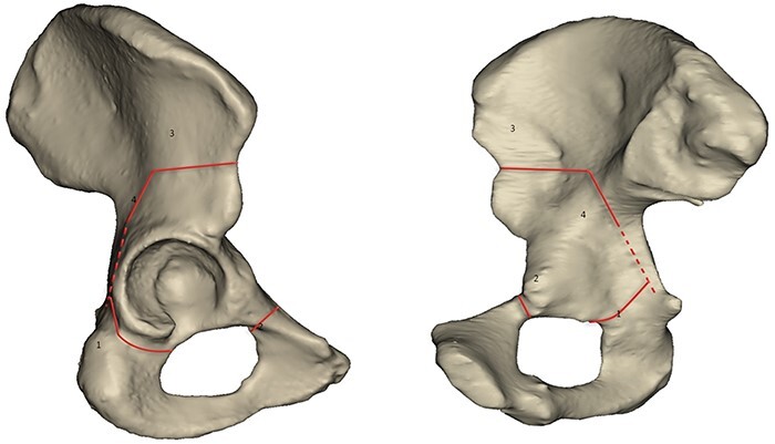 Understanding recurrent groin pain following periacetabular osteotomy: assessment of psoas tendon mechanics using discrete element analysis.