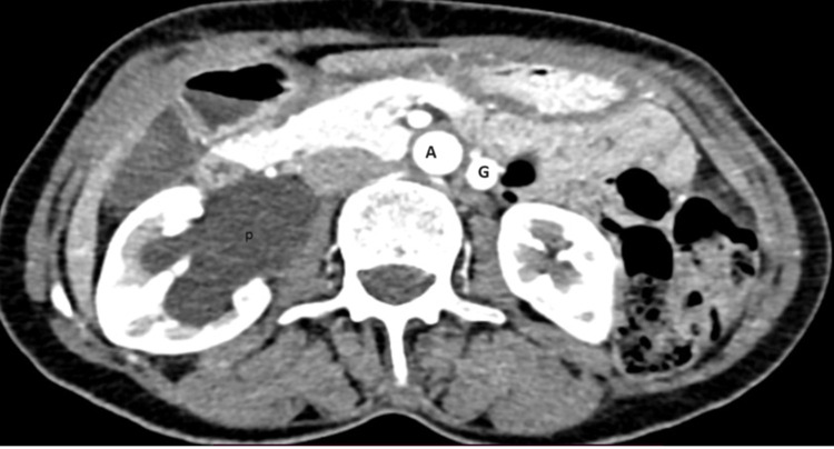 Case Report; Concomitant Left Nutcracker Syndrome and Right Ureteropelvic Junction Obstruction.