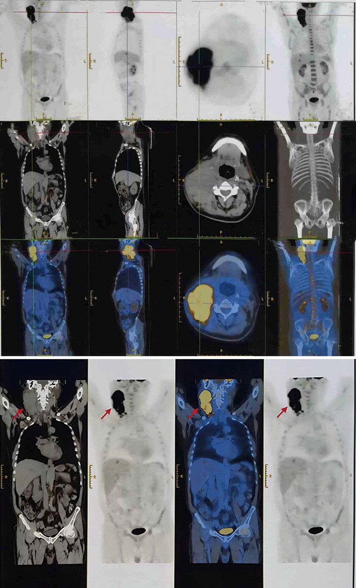 A sarcomatoid malignancy originating in the right cervical lymph nodes with atypical pathological characteristics: a case report of an incidental finding.