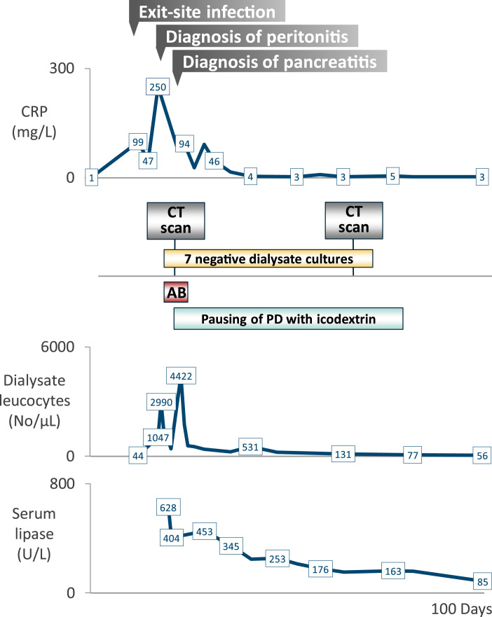 Peritonitis in Peritoneal Dialysis: When to Consider Acute Pancreatitis? Case Report and Mini-Review.