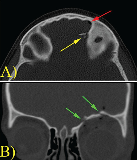 Orbital Cerebrospinal Fluid Leak After Dog Bite: A Case Report