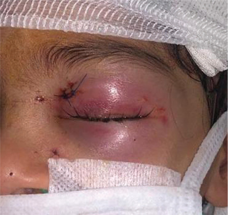 Orbital Cerebrospinal Fluid Leak After Dog Bite: A Case Report