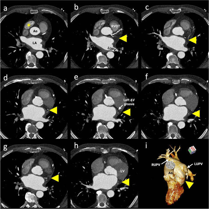 Confirmation of absence: the need for advanced imaging of the left atrial appendage.