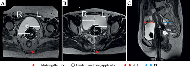 MRI-guided brachytherapy for cervical cancer treatment: The significance of bladder morphology in dose distribution planning.