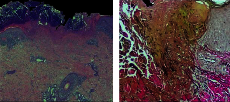 Successful Use of Dupilumab in the Treatment of Acquired Perforating Dermatosis Associated with Atopic Dermatitis.
