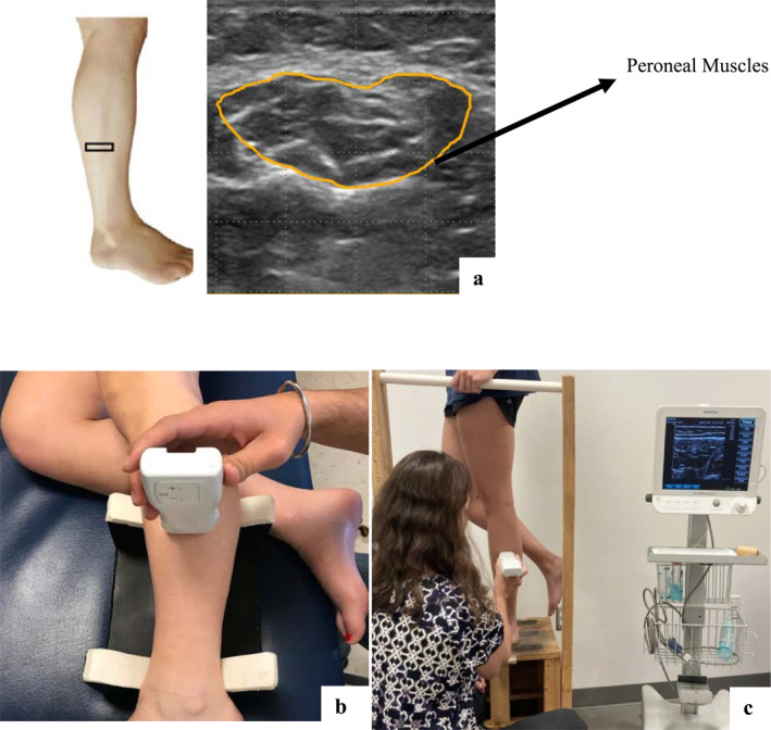 Impairments in peroneal muscle size and activation in individuals with patellofemoral pain in weight-bearing position.