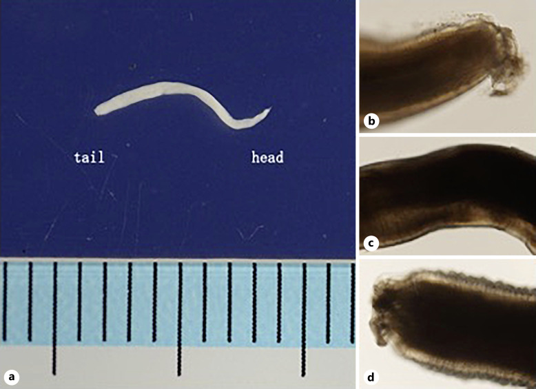 A Case of Nonagenarian Gastric Anisakiasis with Atypical Presentation.