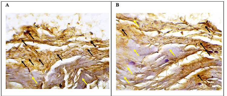 Effect of human umbilical cord stem cells (HUMSC) administration on collagen expression in the anterior vaginal wall in menopausal rats.