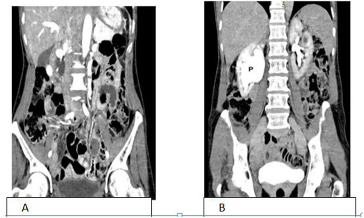 Case Report; Concomitant Left Nutcracker Syndrome and Right Ureteropelvic Junction Obstruction.